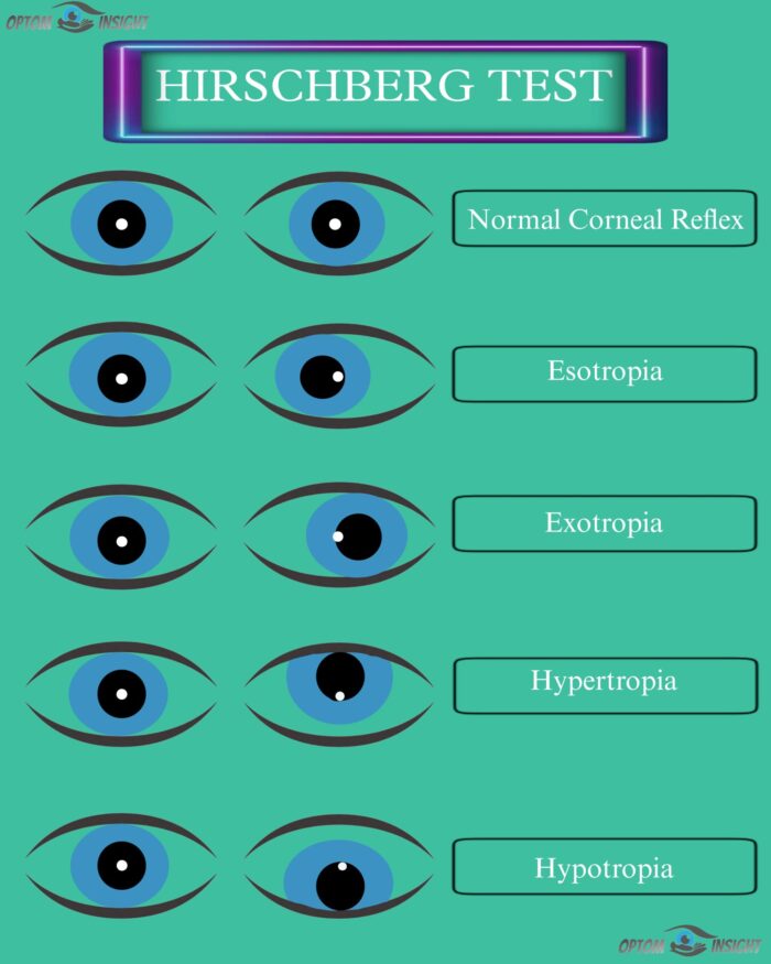 hirschberg corneal reflex test