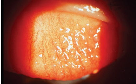 Soft contact lens complication infection and inflammation